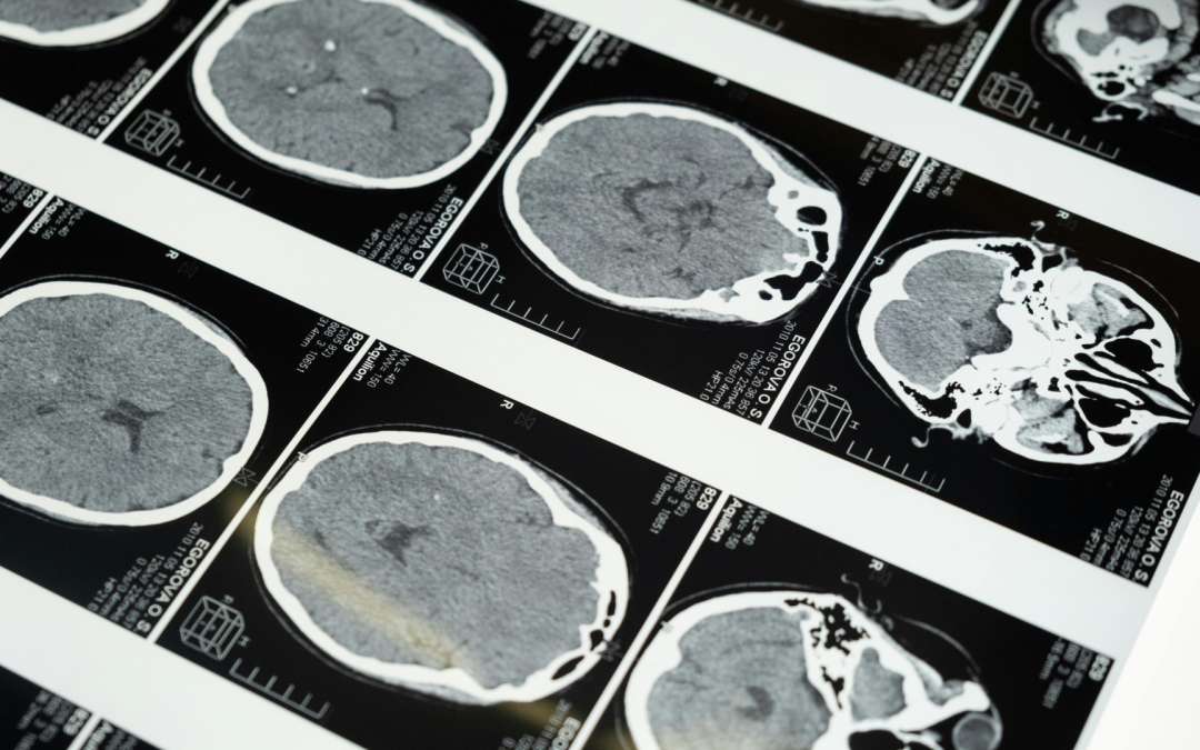 Neuroinflammation and Stress